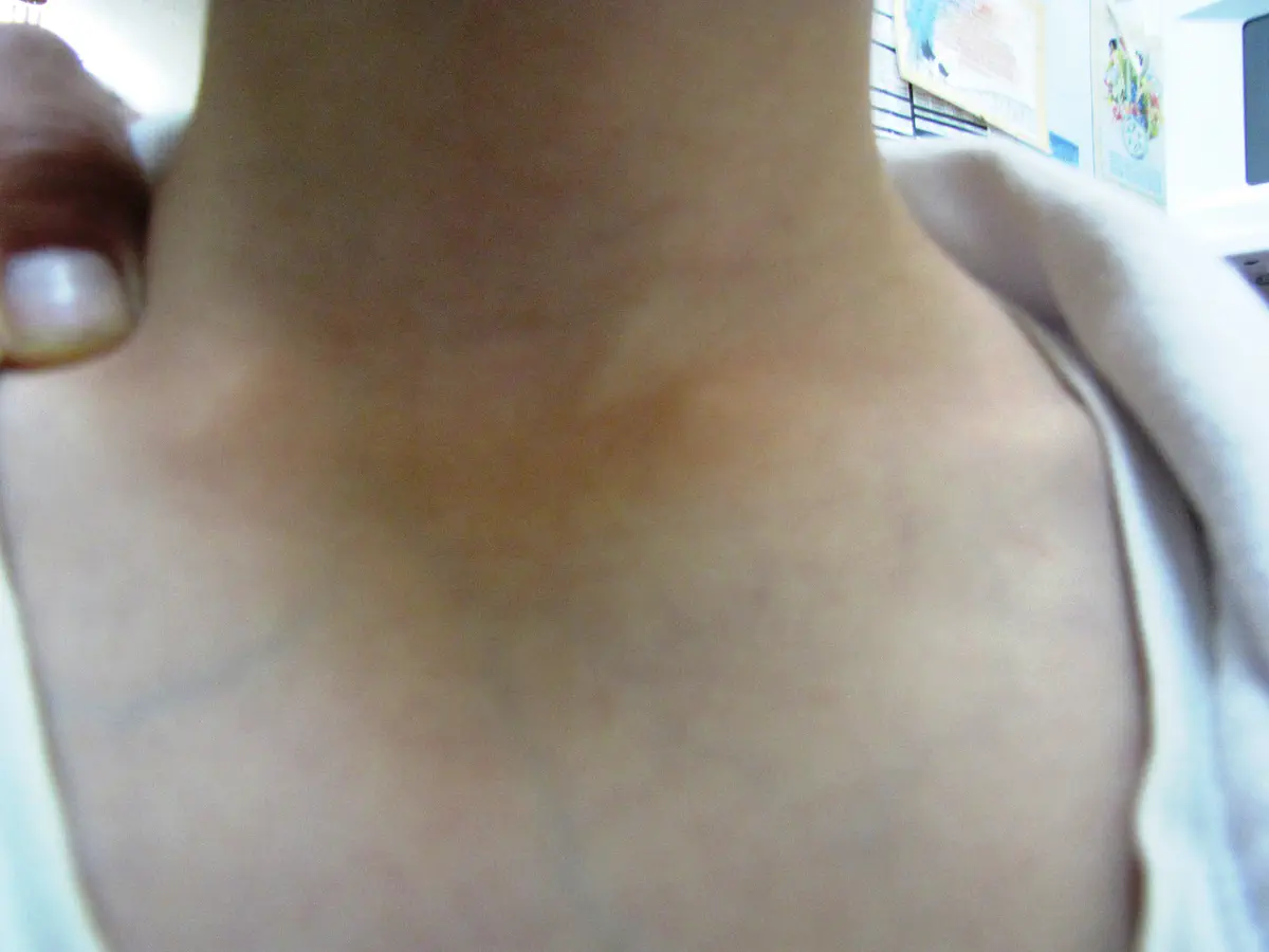 סימני החניקה על צווארו של הילד