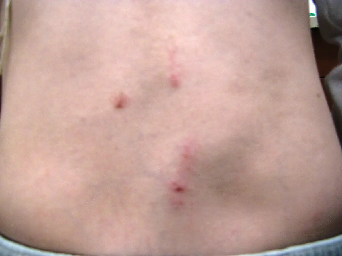 פצעים בגבו של הילד