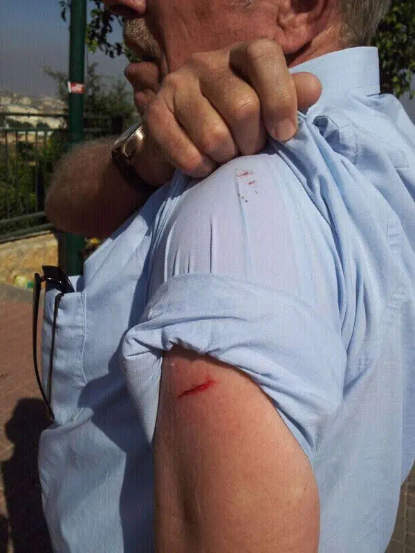 פציעתו של יואל צור