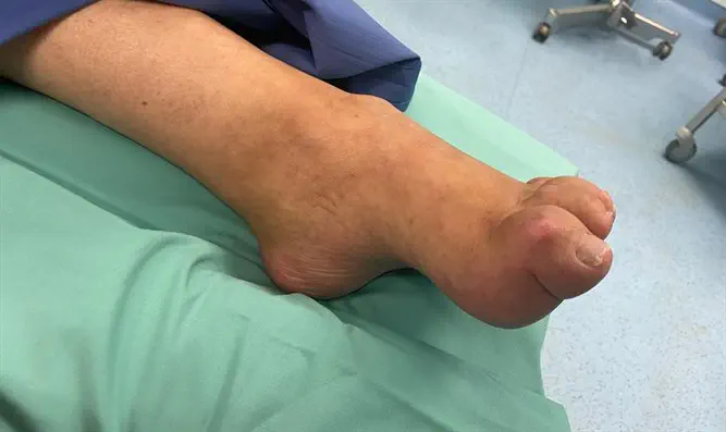 המתין 60 שנה ונותח בהצלחה