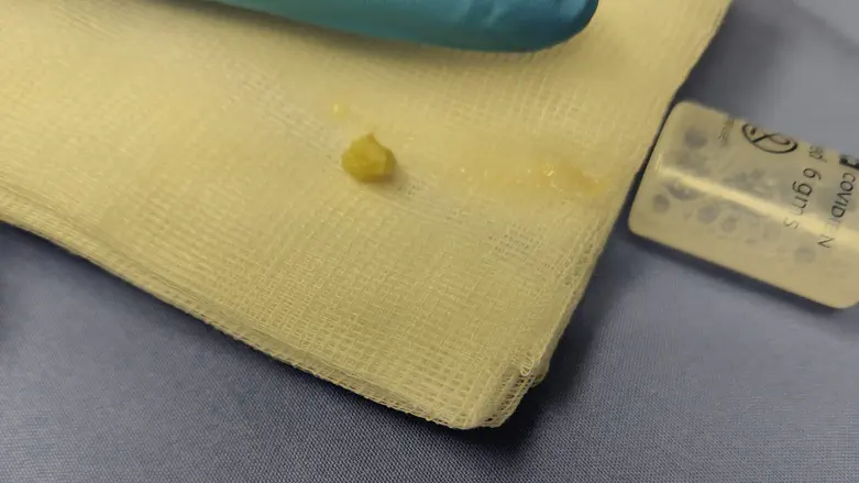 חתיכת שקד זעירה כמעט חנקה פעוטה בת שנתיים