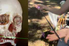 Boy survives rare skull injury after archery camp accident