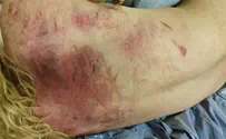 Jewish youth lynched in Jerusalem