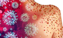 Woman diagnosed with monkeypox