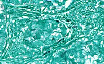 Human tumors are prized real estate for fungi, study finds