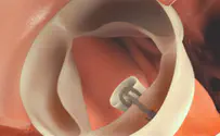 New technology offers minimally-invasive heart valve solution