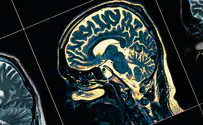 Childhood onset schizophrenia study finds possible genetic cause