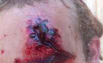 Arab rioters set fire, injure Jewish man with stone near Homesh