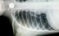 Baby's life saved at Hadassah after swallowing a battery