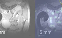 New MRI method 'lights up' pancreatic cancer