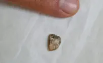 אבן התגלתה באפה של ילדה בת 4