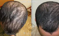 Opt for a PRP treatment today and get your confidence back