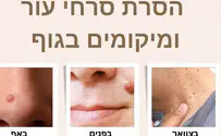 הסרת סרחי עור – השוואה לקליניקות פרטיות