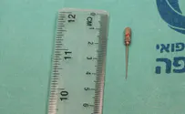 המחט שנבלעה בשוגג בעת טיפול שיניים נשלפה