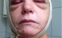 Swedish Jewish Woman Savagely Beaten for Wearing Star of David
