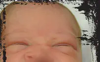 Baby Was Born Without An Upper Lip