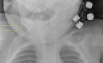 Antenna extracted from baby's throat in northern Israel
