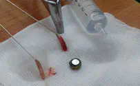 Battery extracted from 4-year-old boy's nose