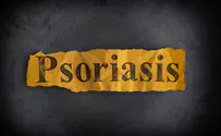צילום: אייסטוק 5,700 חולי פסוריאזיס חדשים בשנה