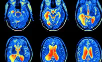 Hebrew U's new MRI can 'see' molecular changes in the brain