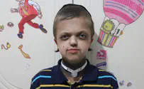 Jerusalem boy's struggle with facial deformity