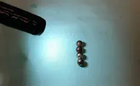 Four magnets extracted from 5-year-old boy's stomach