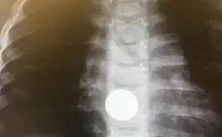 Child swallowed battery? Give honey immediately