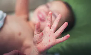 Chief rabbis urge Israelis to vaccinate amid measles outbreak