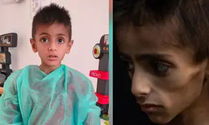 'Starved' Gaza child suffers from genetic illness and is in Italy