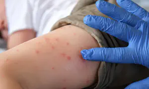 ילד בן תשע שלא חוסן נפטר מחצבת