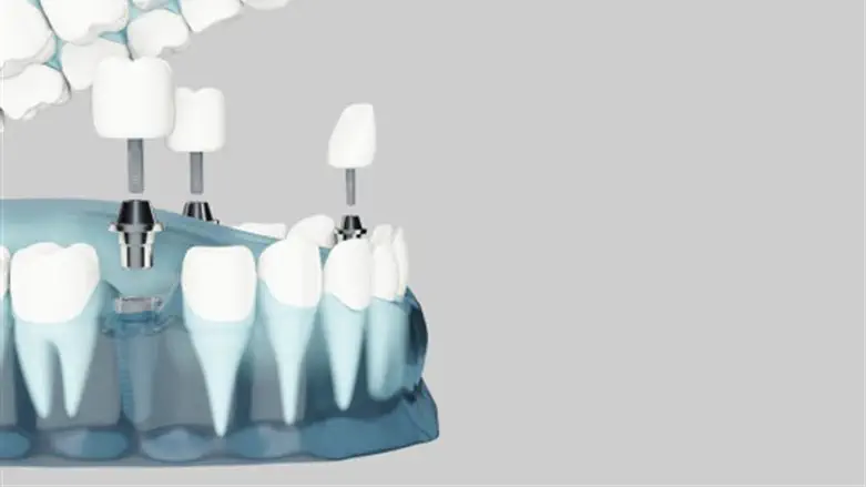 השתלות שיניים 