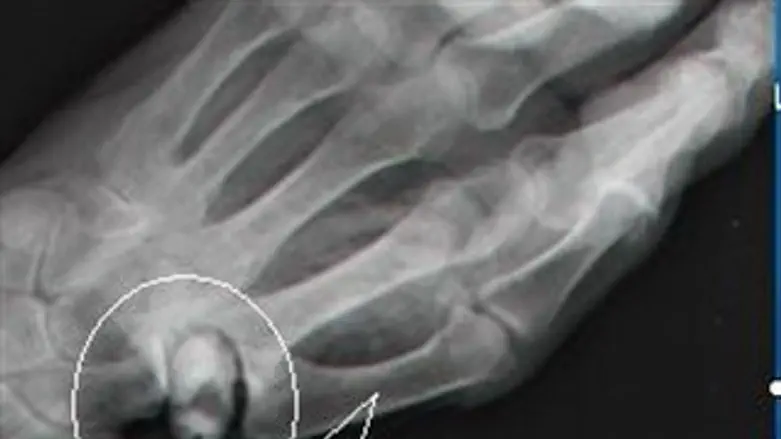 השתל המתכלה בצילום רנטגן