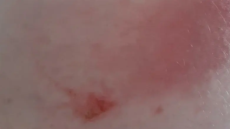 гематома и кровь на теле после нападения арабов