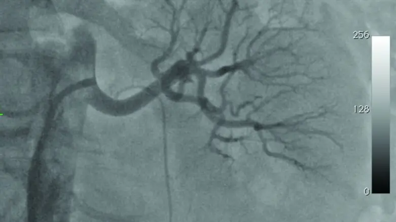 צנתור לטיפול בלחץ דם