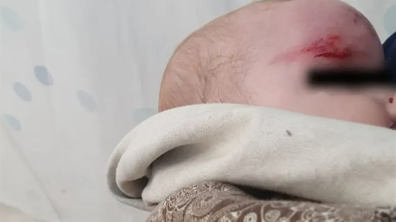 The baby who was injured by the stone-throwing