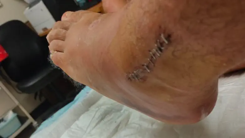 החבלה ברגלו