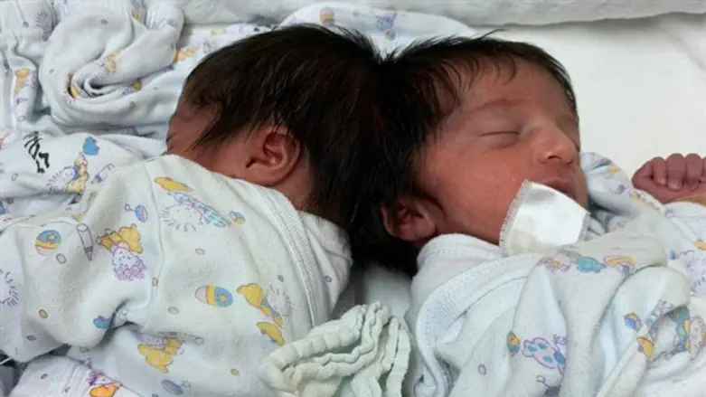 the twins before the separation