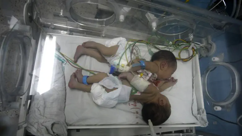 תאומים סיאמים. ארכיון