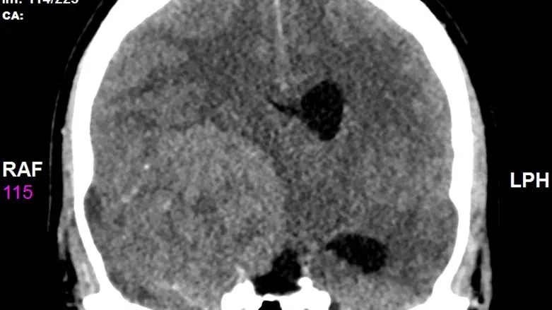 הגידול בראש