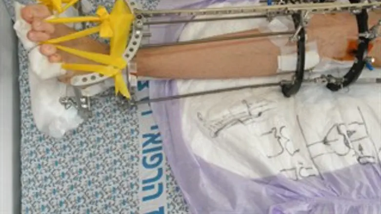 הצעיר לאחר הניתוח