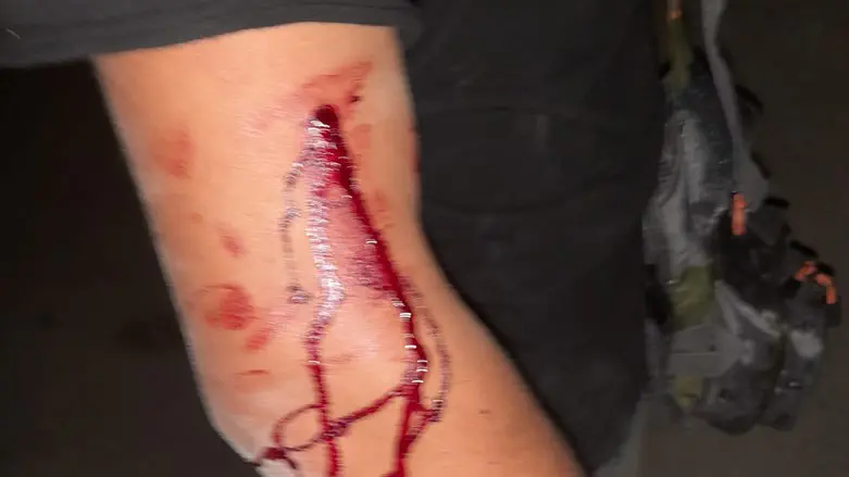 Пострадавший в результате нападения в Акко