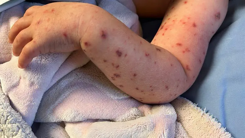 הפריחה ממנה סבלה הפעוטה