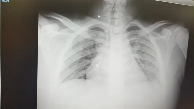 הנפילה סיפקה את התנאים להובלת הבורג הגדול לריאה