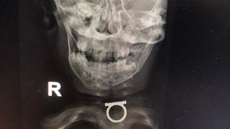 הטבעת בוושט הפעוט - כפי שנראתה בצילום רנטגן