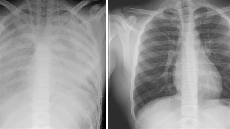 מימין צילום ריאות תקין. משמאל צילום ריאותיו של הנער