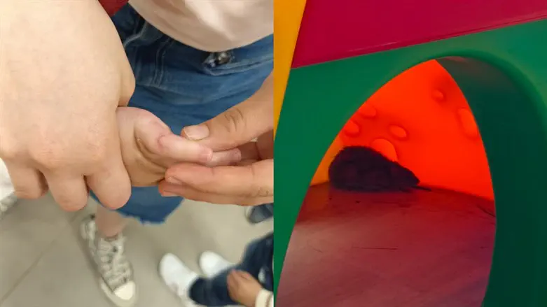 child bitten by rat