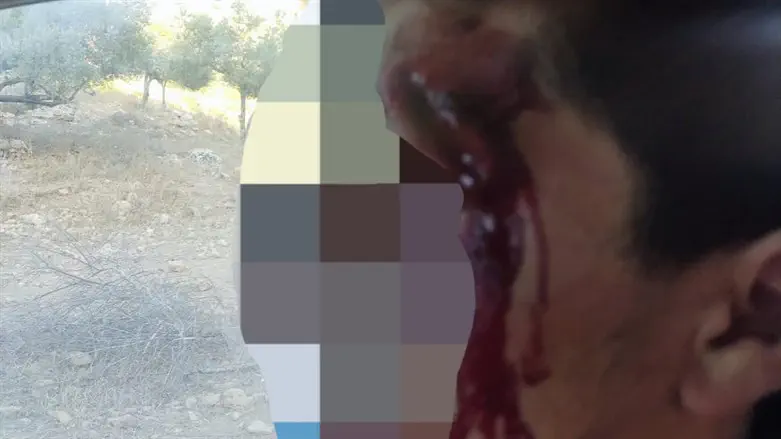One of the farmers injured in the attacks