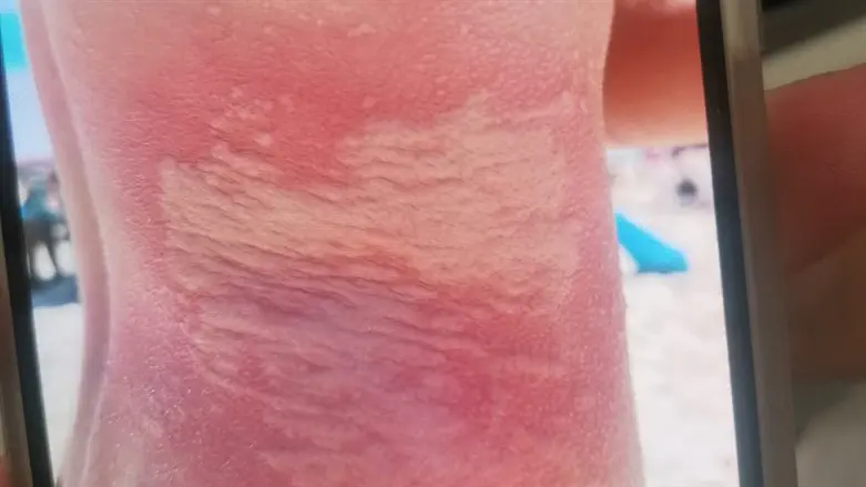 הצריבה הקשה של הנער