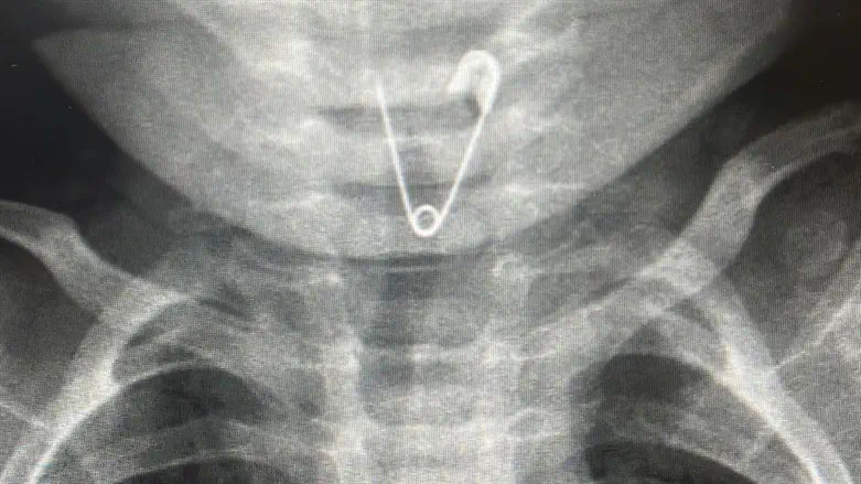 The x-ray in which the safety pin was discovered