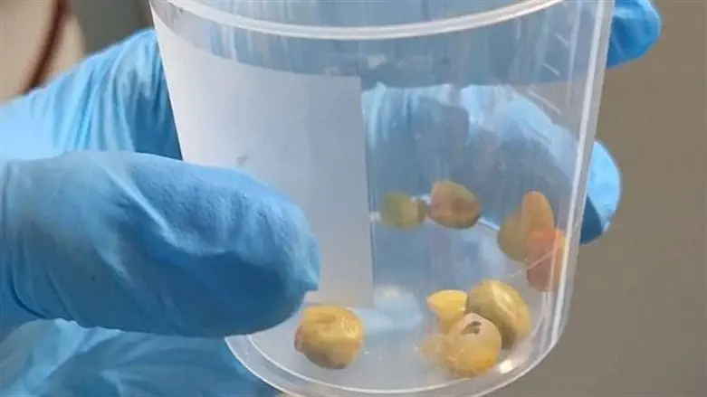 העצמים הזרים שהוצאו מקנה הנשימה של החולה